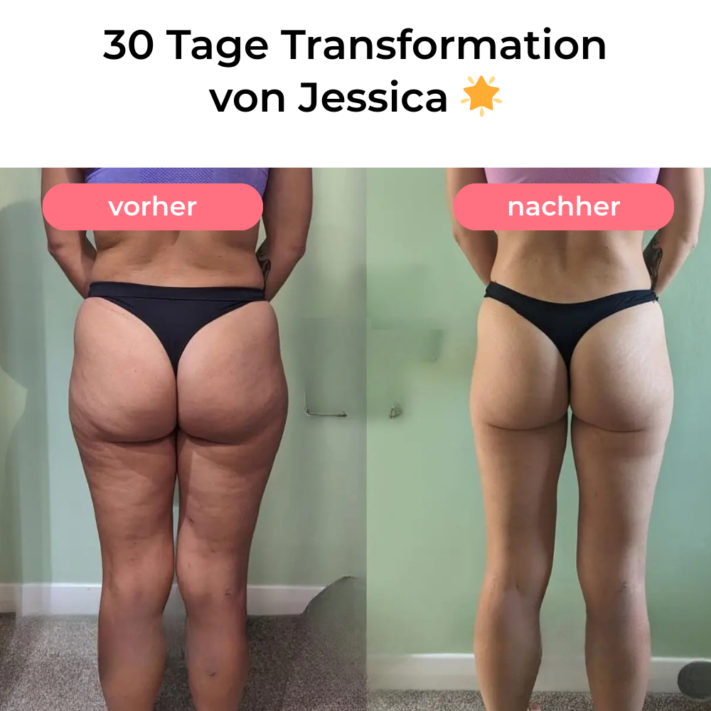 Anti-Cellulite Massagegerät
